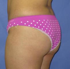 Liposuction Before & After Patient #271