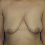 Breast Augmentation Before & After Patient #7447