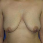 Breast Augmentation Before & After Patient #7447