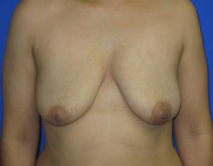 Breast Augmentation Before & After Patient #7447