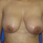 Breast Augmentation Before & After Patient #7447