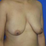 Breast Augmentation Before & After Patient #7447