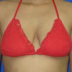 Breast Augmentation Before & After Patient #7452