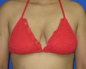 Breast Augmentation Before & After Patient #7452