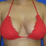 Breast Augmentation Before & After Patient #7452