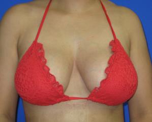 Breast Augmentation Before & After Patient #7452