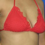 Breast Augmentation Before & After Patient #7452