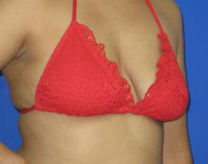 Breast Augmentation Before & After Patient #7452