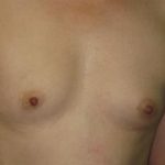 Breast Augmentation Before & After Patient #7457