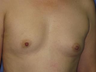 Breast Augmentation Before & After Patient #7457