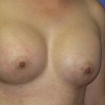 Breast Augmentation Before & After Patient #7457