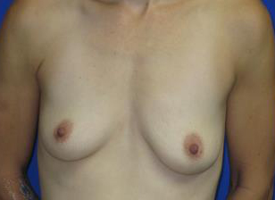 Breast Augmentation Before & After Patient #7466
