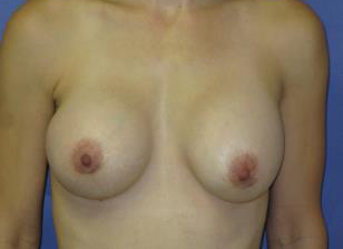 Breast Augmentation Before & After Patient #7466