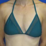 Breast Augmentation Before & After Patient #7469