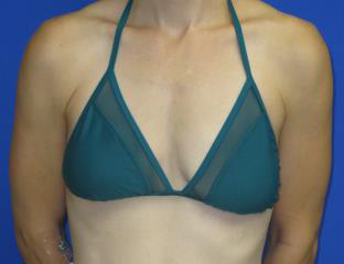 Breast Augmentation Before & After Patient #7469