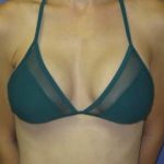 Breast Augmentation Before & After Patient #7469