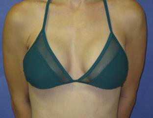 Breast Augmentation Before & After Patient #7469