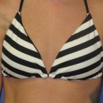 Breast Augmentation Before & After Patient #7472