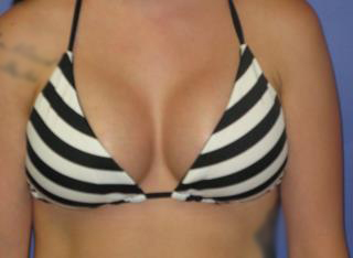 Breast Augmentation Before & After Patient #7472