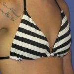 Breast Augmentation Before & After Patient #7472
