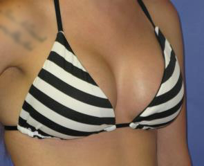 Breast Augmentation Before & After Patient #7472