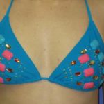 Breast Augmentation Before & After Patient #7477