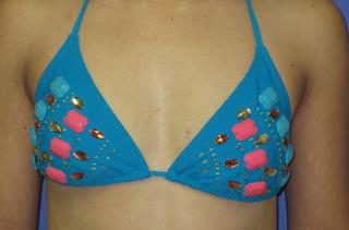 Breast Augmentation Before & After Patient #7477