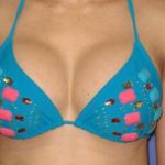 Breast Augmentation Before & After Patient #7477