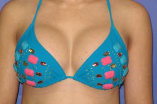 Breast Augmentation Before & After Patient #7477