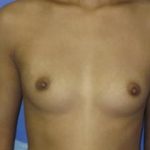 Breast Augmentation Before & After Patient #7480