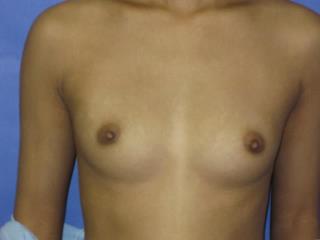 Breast Augmentation Before & After Patient #7480