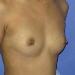 Breast Augmentation Before & After Patient #7480