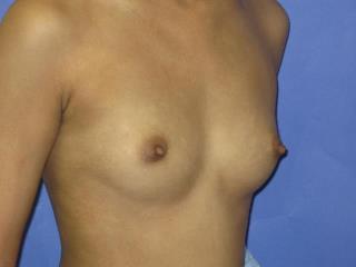 Breast Augmentation Before & After Patient #7480