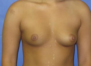 Breast Augmentation Before & After Patient #7485