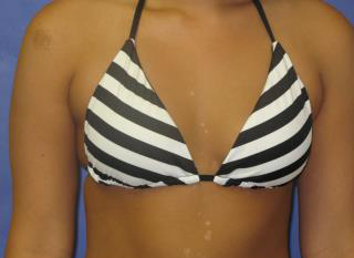 Breast Augmentation Before & After Patient #7523
