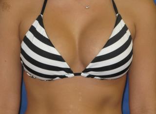 Breast Augmentation Before & After Patient #7523