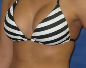 Breast Augmentation Before & After Patient #7523