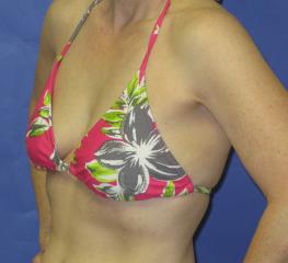 Breast Augmentation Before & After Patient #7520
