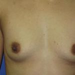 Breast Augmentation Before & After Patient #7512