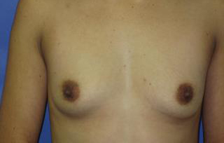 Breast Augmentation Before & After Patient #7512