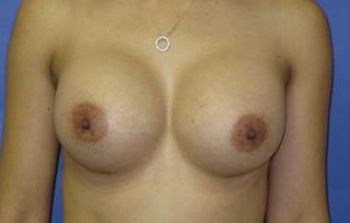 Breast Augmentation Before & After Patient #7512