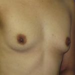 Breast Augmentation Before & After Patient #7512