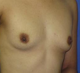 Breast Augmentation Before & After Patient #7512