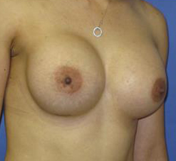 Breast Augmentation Before & After Patient #7512