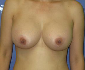 Breast Augmentation Before & After Patient #7507