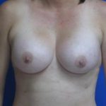 Breast Augmentation Before & After Patient #7504