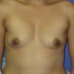 Breast Augmentation Before & After Patient #7496