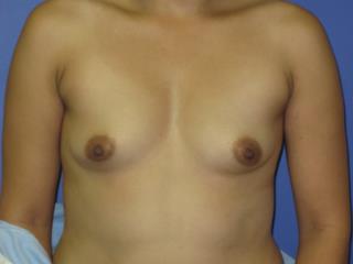 Breast Augmentation Before & After Patient #7496