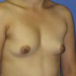 Breast Augmentation Before & After Patient #7496