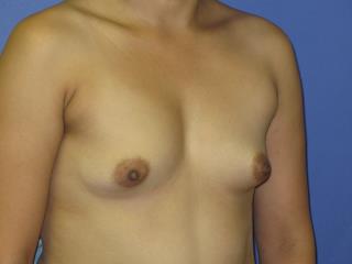 Breast Augmentation Before & After Patient #7496